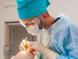 کاشت مو به روش FUE چیست؟ 6 10 کلینیک برتر کاشت مو در شیراز 1