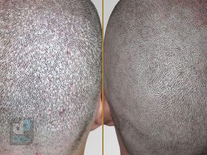 کاشت مو به روش FUE چیست؟ 4 کاشت مو به روش تکثیر در شیراز