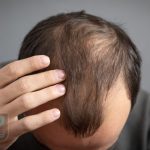 کاشت مو دائمی است عکس شاخص