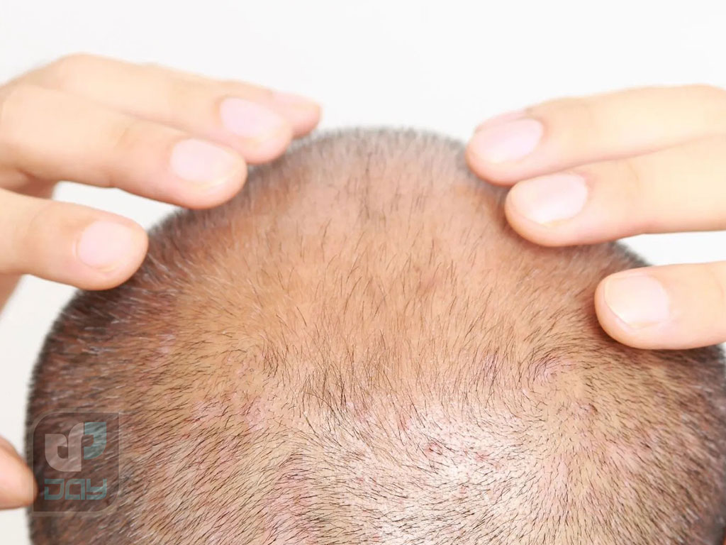 آیا کاشت مو دائمی است؟ 2 کاشت مو دائمی است؟