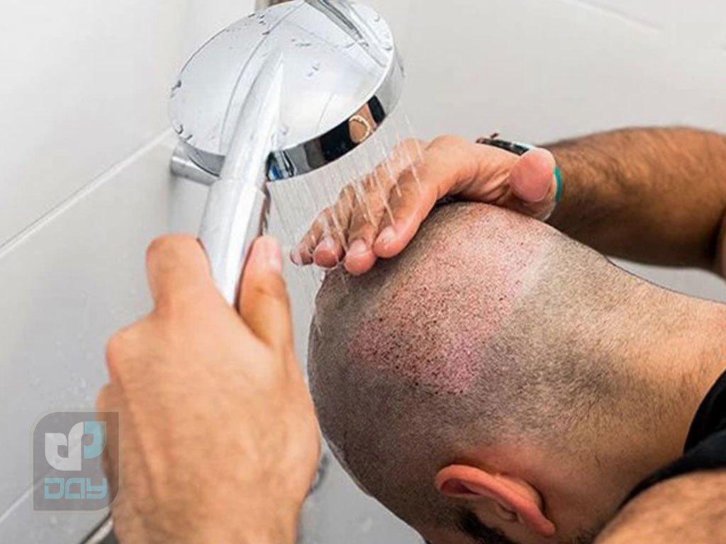 شستشوی سر بعد از کاشت مو؛ راهنمای گامبهگام و روز به روز 5 اشتباهات خطرناک در شست و شوی سر بعد از کاشت