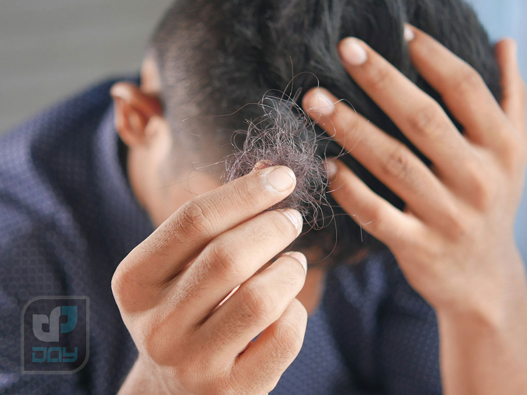 آیا ریزش مو بعد از کاشت طبیعی است؟ 3 ریزش مو بعد از کاشت طبیعی است