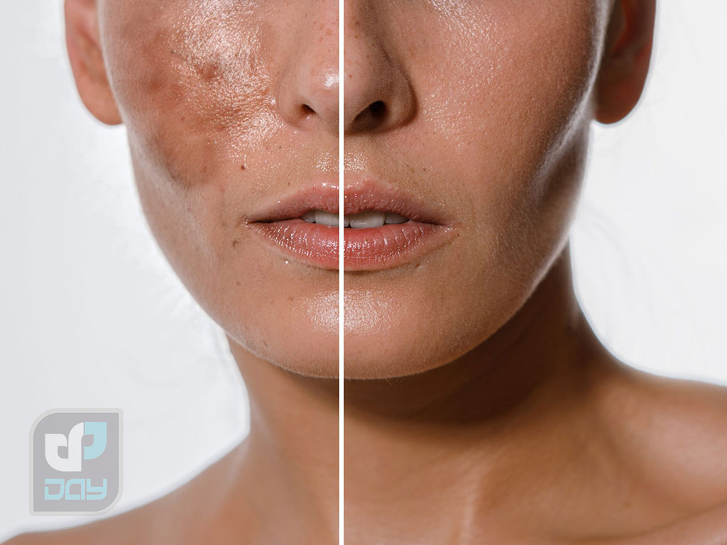 آیا لیزر صورت باعث لک میشود؟ 5 چگونه از لک بعد از لیزر جلوگیری کنیم