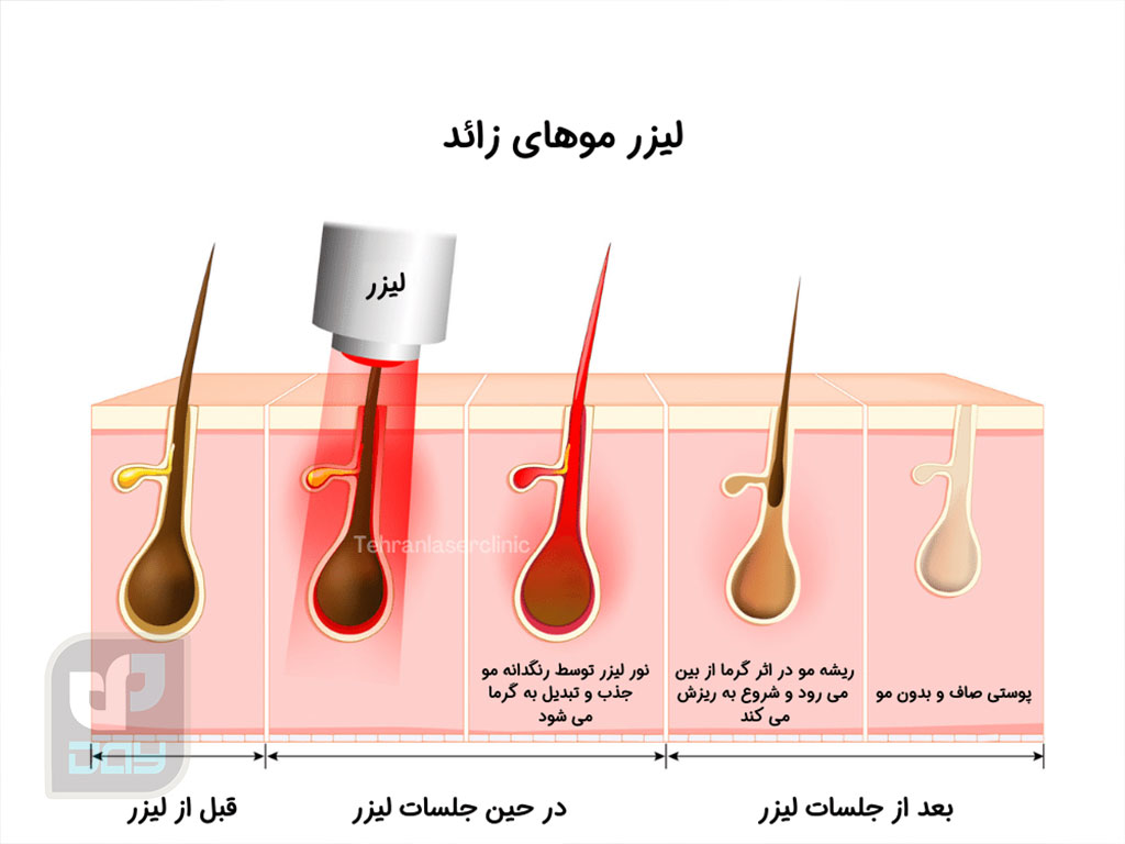 تعداد جلسات لیزر موهای زائد چقدر است؟ 4 تعداد جلسات لیزر موهای زائد و نتیجه چرخه رشد مو